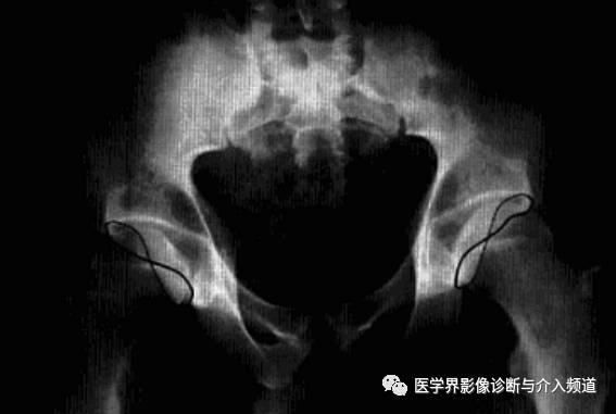 12种髋关节病变的影像鉴别诊断 12种髋关节病变的影像鉴别诊断