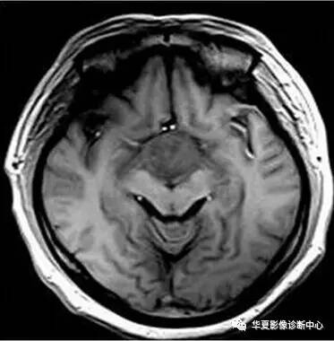 【病例】第三脑室脊索样胶质瘤1例MR影像表现