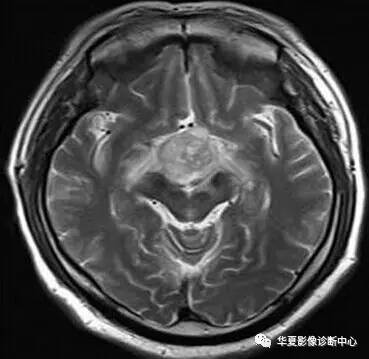 【病例】第三脑室脊索样胶质瘤1例MR影像表现