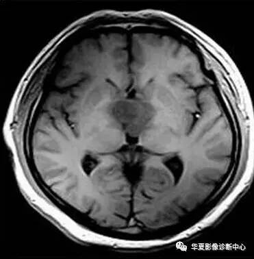 【病例】第三脑室脊索样胶质瘤1例MR影像表现