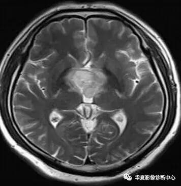 【病例】第三脑室脊索样胶质瘤1例MR影像表现