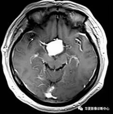 【病例】第三脑室脊索样胶质瘤1例MR影像表现