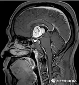 【病例】第三脑室脊索样胶质瘤1例MR影像表现