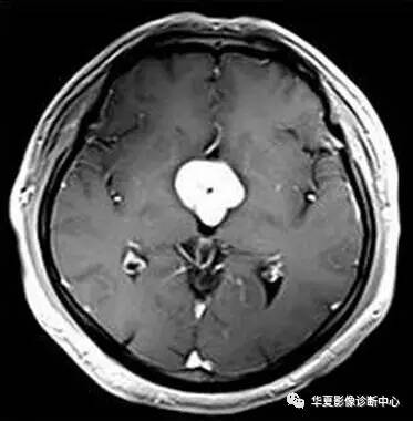 【病例】第三脑室脊索样胶质瘤1例MR影像表现