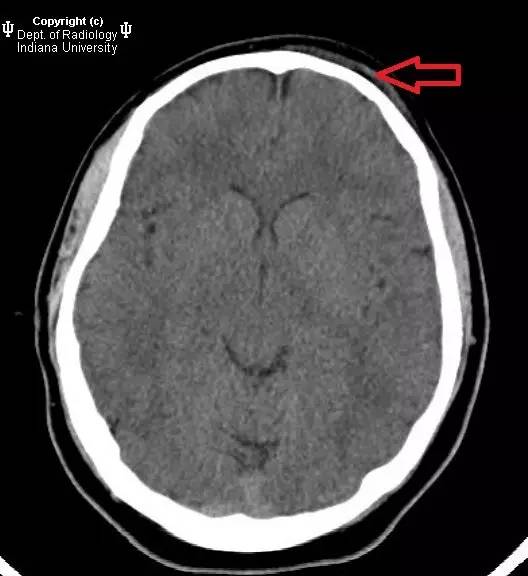 【病例】鼻窦炎引起波特氏头皮肿块一例CT