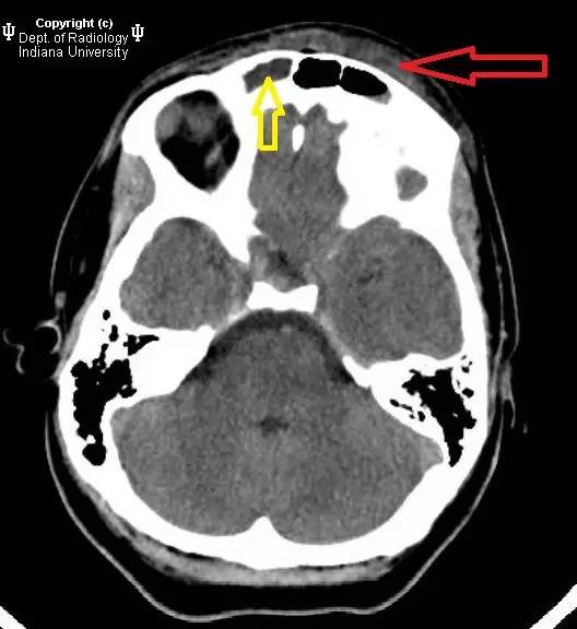 【病例】鼻窦炎引起波特氏头皮肿块一例CT