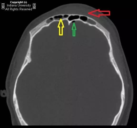 【病例】鼻窦炎引起波特氏头皮肿块一例CT