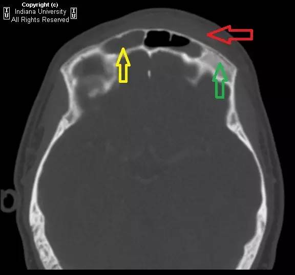 【病例】鼻窦炎引起波特氏头皮肿块一例CT