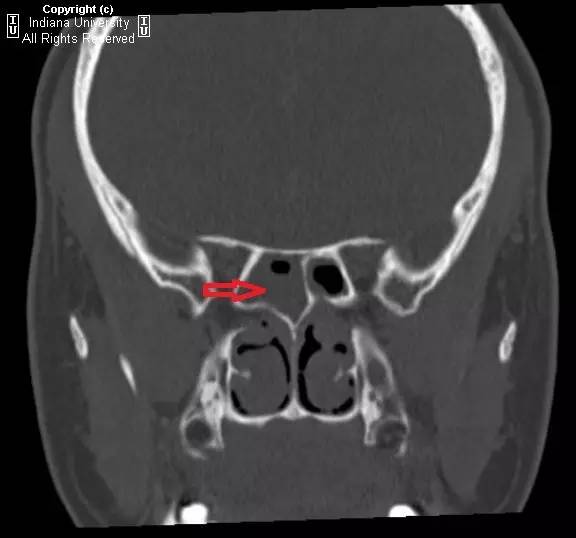 【病例】鼻窦炎引起波特氏头皮肿块一例CT