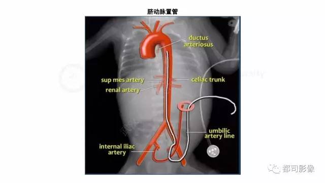 【PPT】新生儿置管的影像学评价