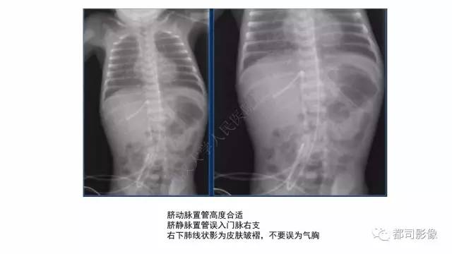 【PPT】新生儿置管的影像学评价