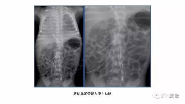 【PPT】新生儿置管的影像学评价