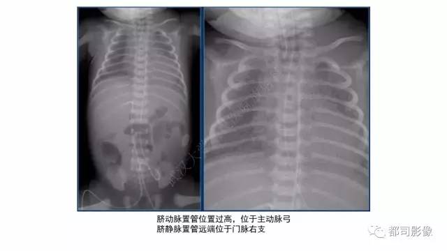 【PPT】新生儿置管的影像学评价