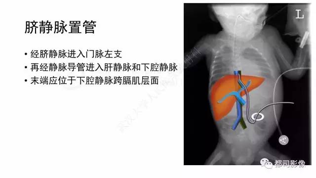 【PPT】新生儿置管的影像学评价