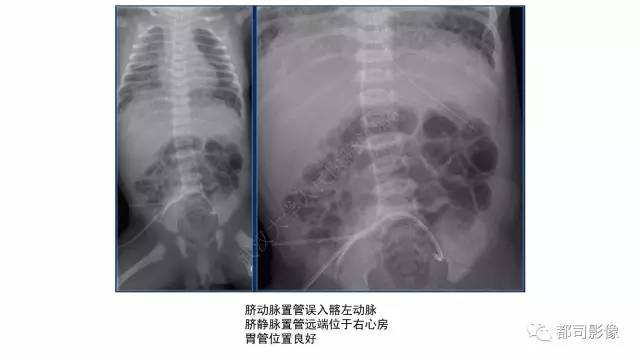 【PPT】新生儿置管的影像学评价