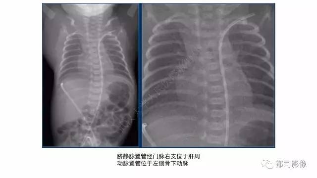 【PPT】新生儿置管的影像学评价
