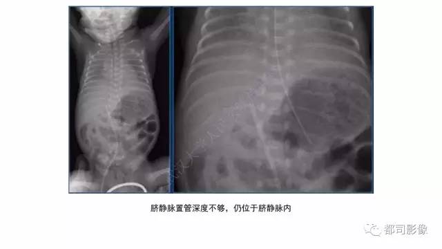 【PPT】新生儿置管的影像学评价