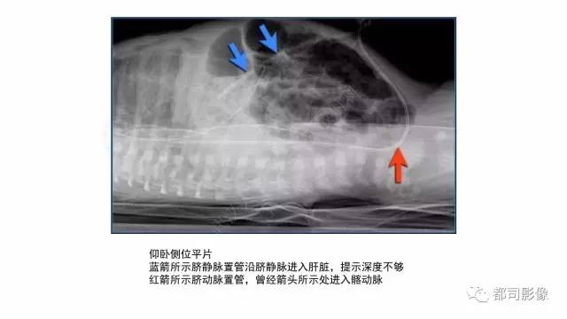 【PPT】新生儿置管的影像学评价
