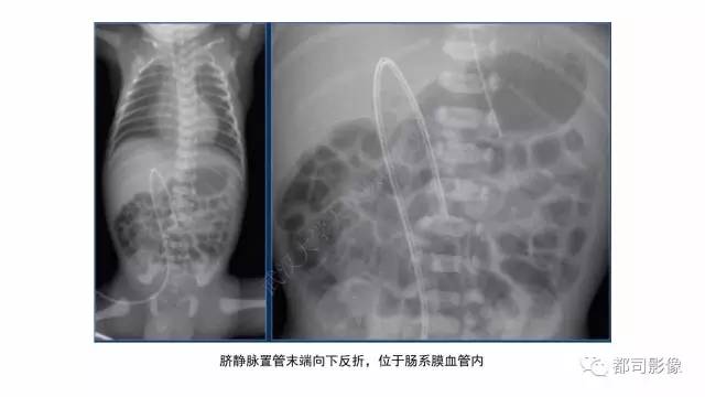 【PPT】新生儿置管的影像学评价