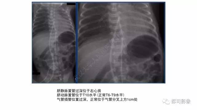 【PPT】新生儿置管的影像学评价