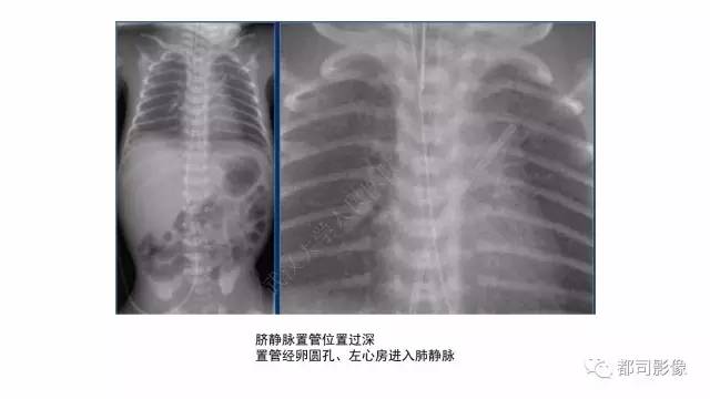 【PPT】新生儿置管的影像学评价