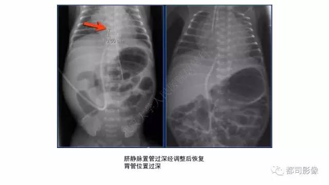 【PPT】新生儿置管的影像学评价