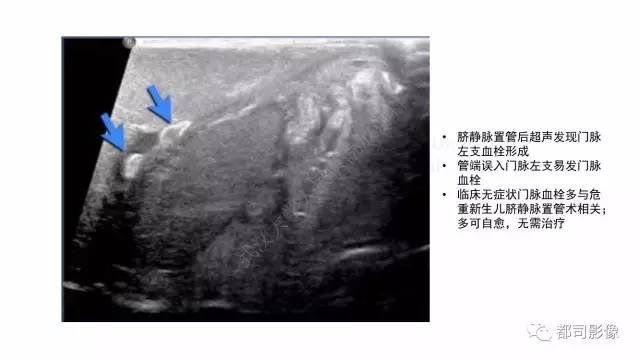 【PPT】新生儿置管的影像学评价