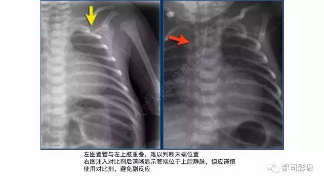 【PPT】新生儿置管的影像学评价
