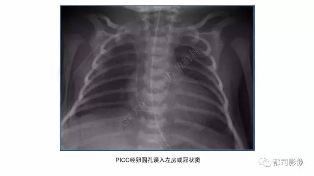 【PPT】新生儿置管的影像学评价