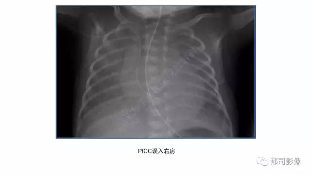 【PPT】新生儿置管的影像学评价