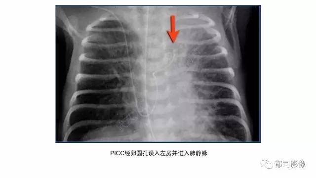 【PPT】新生儿置管的影像学评价
