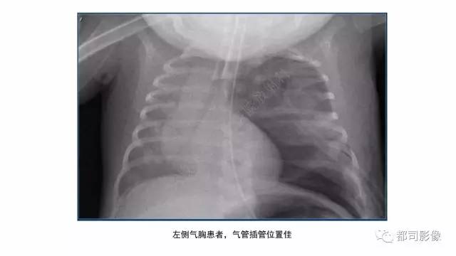 【PPT】新生儿置管的影像学评价