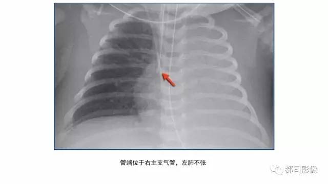 【PPT】新生儿置管的影像学评价