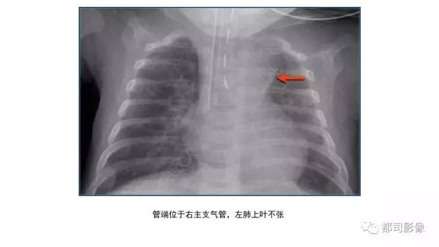 【PPT】新生儿置管的影像学评价