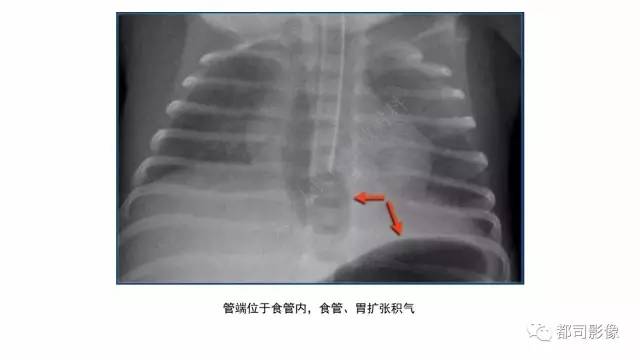 【PPT】新生儿置管的影像学评价