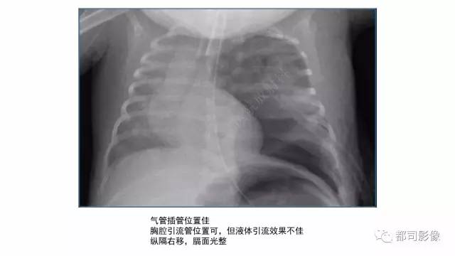 【PPT】新生儿置管的影像学评价