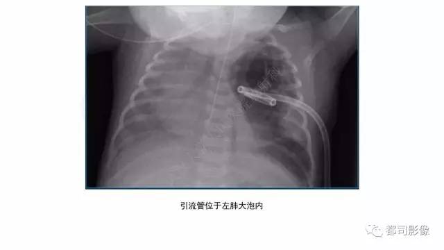 【PPT】新生儿置管的影像学评价