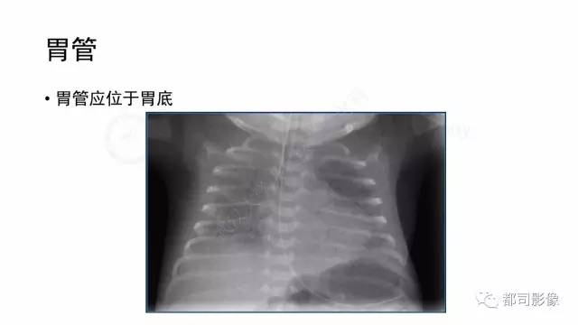 【PPT】新生儿置管的影像学评价