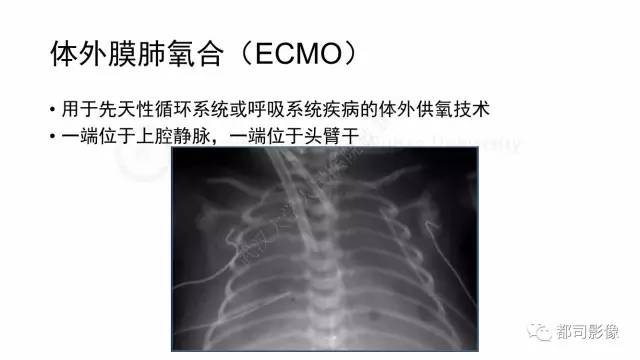 【PPT】新生儿置管的影像学评价