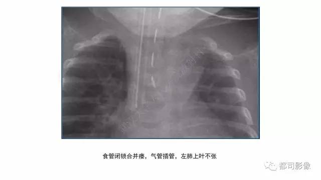 【PPT】新生儿置管的影像学评价