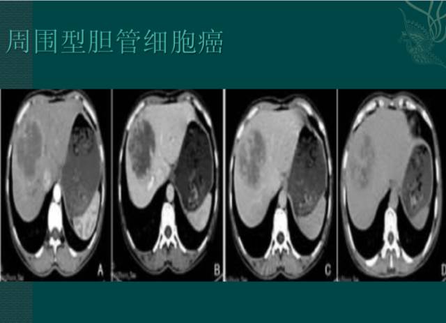 【病例】右肝胆管细胞癌1例CT影像表现 【病例】右肝胆管细胞癌1例CT影像表现