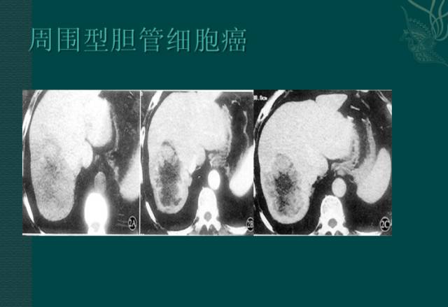 【病例】右肝胆管细胞癌1例CT影像表现 【病例】右肝胆管细胞癌1例CT影像表现