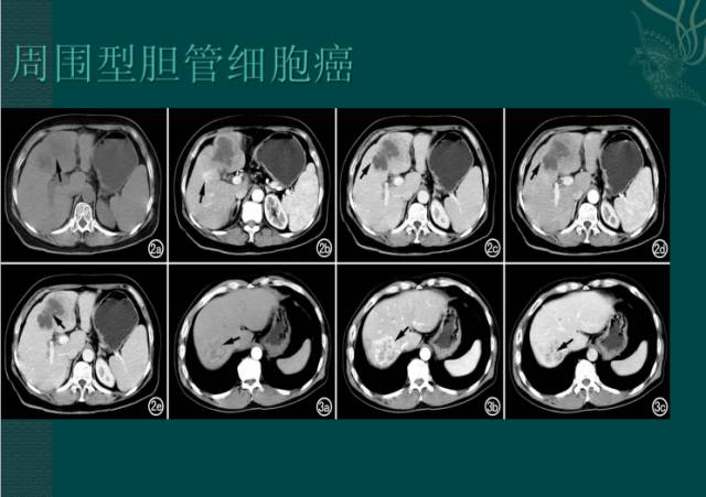 【病例】右肝胆管细胞癌1例CT影像表现 【病例】右肝胆管细胞癌1例CT影像表现