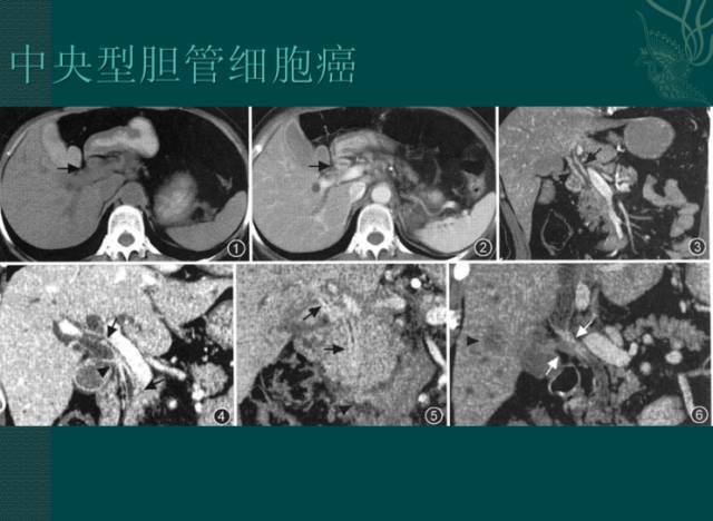 【病例】右肝胆管细胞癌1例CT影像表现 【病例】右肝胆管细胞癌1例CT影像表现