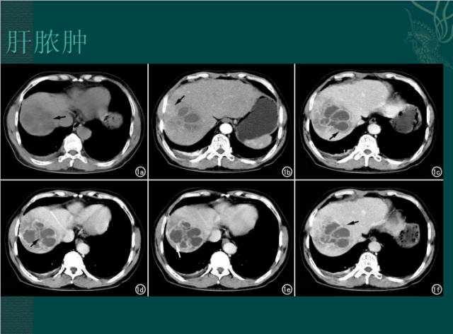 【病例】右肝胆管细胞癌1例CT影像表现 【病例】右肝胆管细胞癌1例CT影像表现