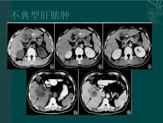 【病例】右肝胆管细胞癌1例CT影像表现 【病例】右肝胆管细胞癌1例CT影像表现