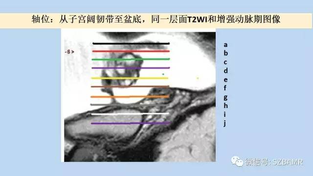 【PPT】女性盆腔、会阴影像解剖与肿瘤定位