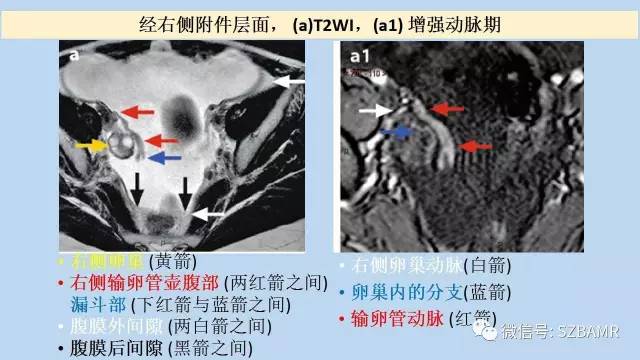 【PPT】女性盆腔、会阴影像解剖与肿瘤定位