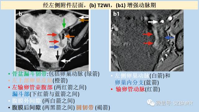 【PPT】女性盆腔、会阴影像解剖与肿瘤定位