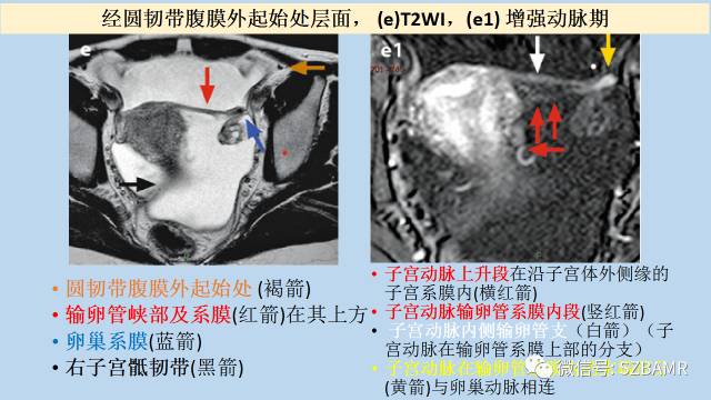 【PPT】女性盆腔、会阴影像解剖与肿瘤定位